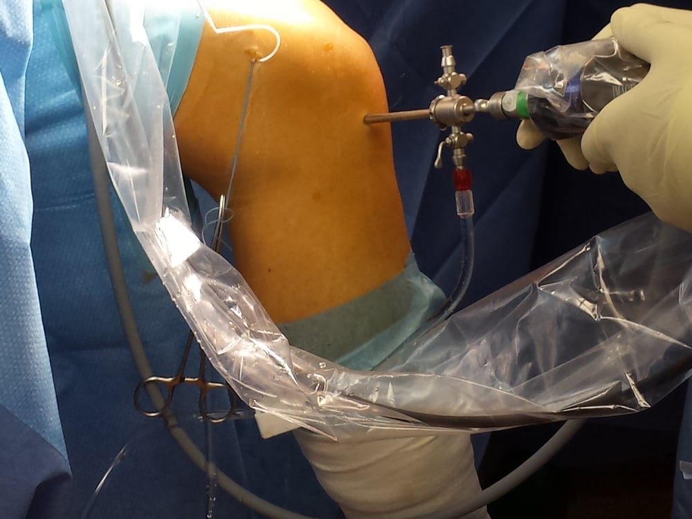A rigid arthroscope entering a cannula with fluid-control stopcocks and an irrigation line, alongside a sterile-draped camera handpiece, during an arthroscopy
