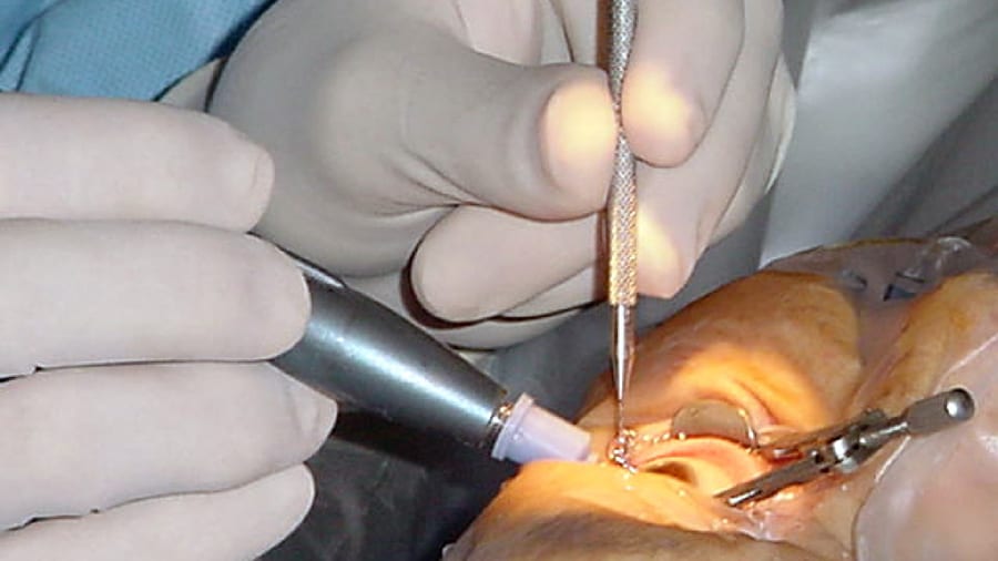A phacoemulsification handpiece and a manipulator instrument being used during cataract surgery